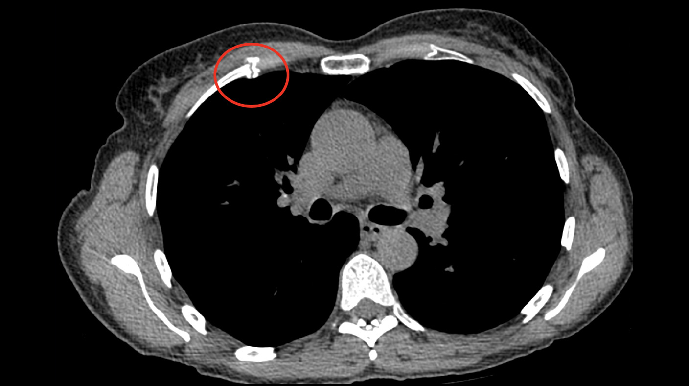 Costochondral fracture with non-union