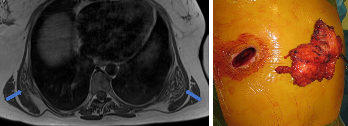 MRI image (left) showing bilateral elastofibroma dors