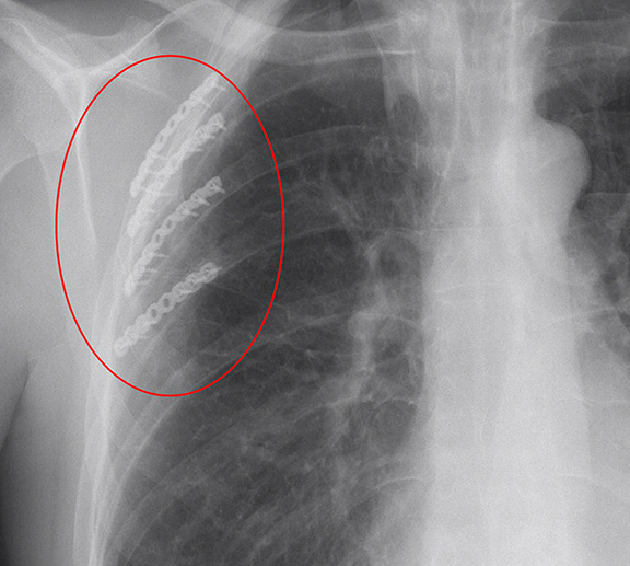 Open reduction and internal Rib fixation