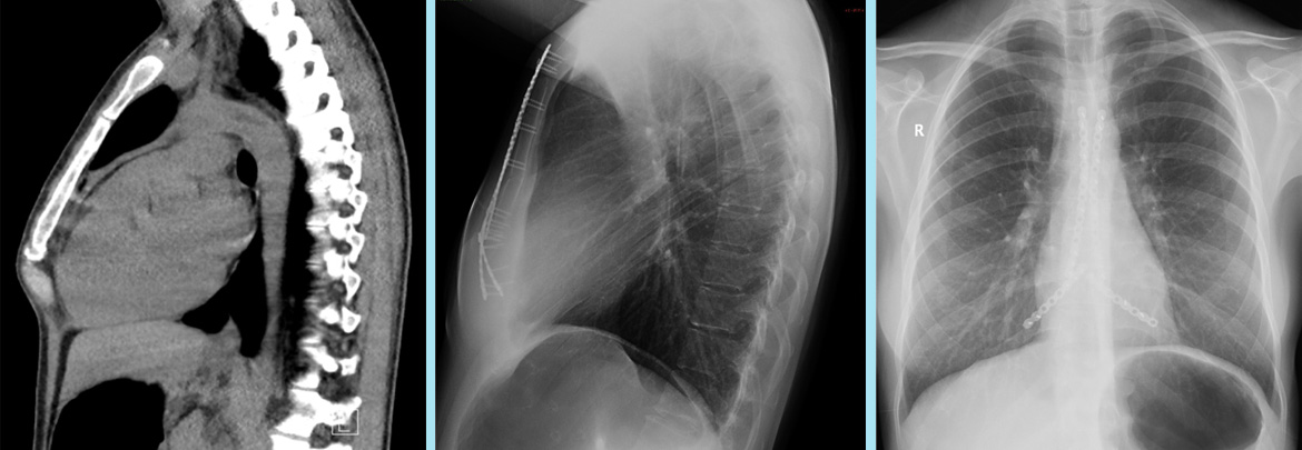 Radiology Image on left shows protruding chest and to the right following correction using metal plates to reconstruct the sternum and chest wall and correct pectus carinatum