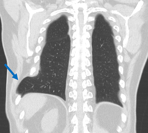 CT image showing chronic lung hernia