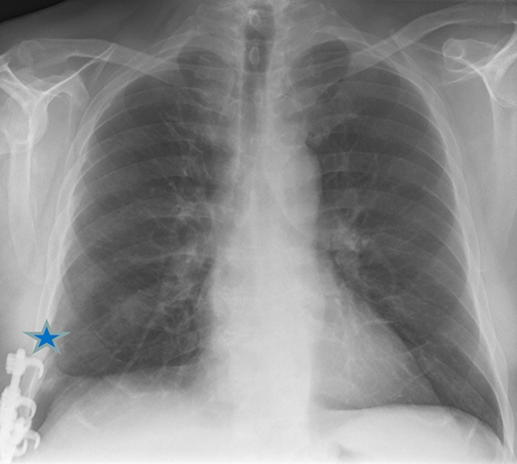 CT image showing chronic lung hernia