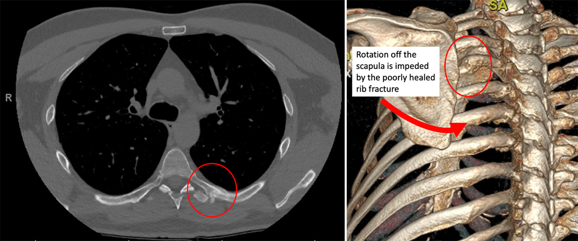 A poorly healed rib fracture