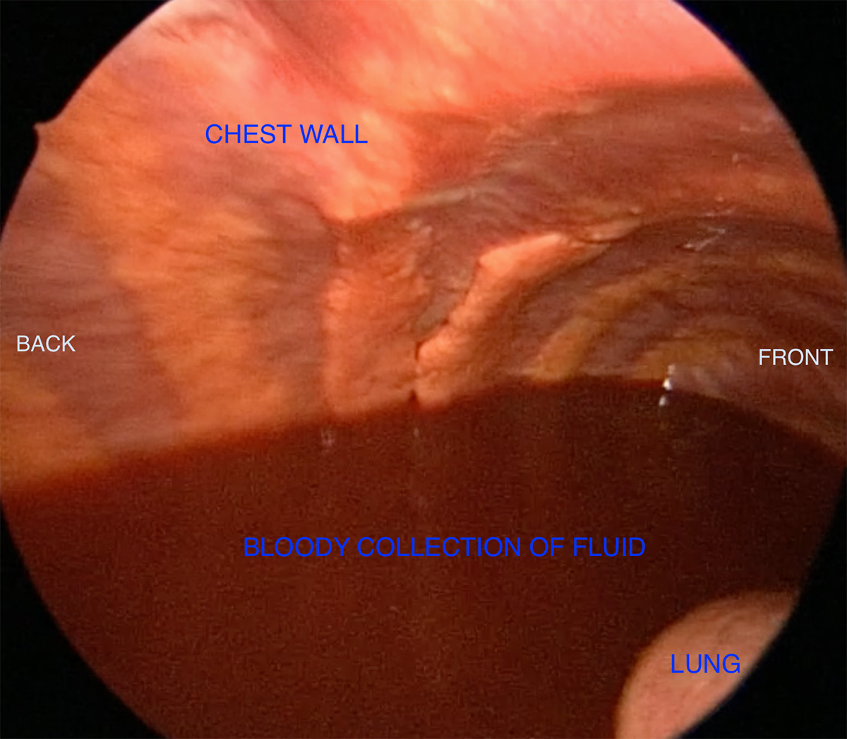 Collection of blood (haemothorax) prior to rib fixation