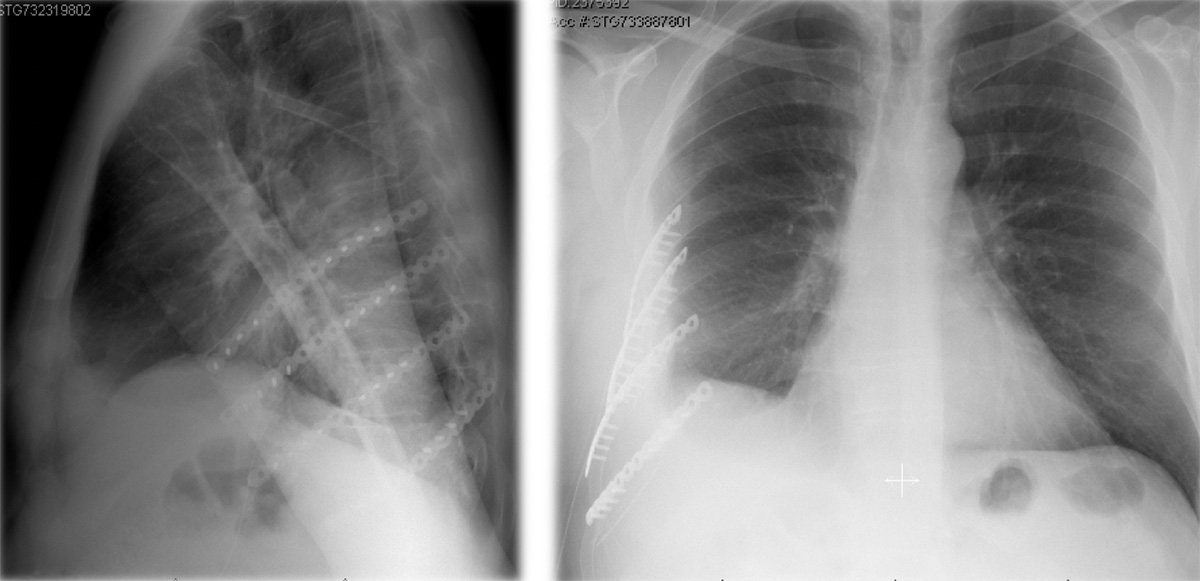 Chest X-ray from the side and front showing multiple rib plates