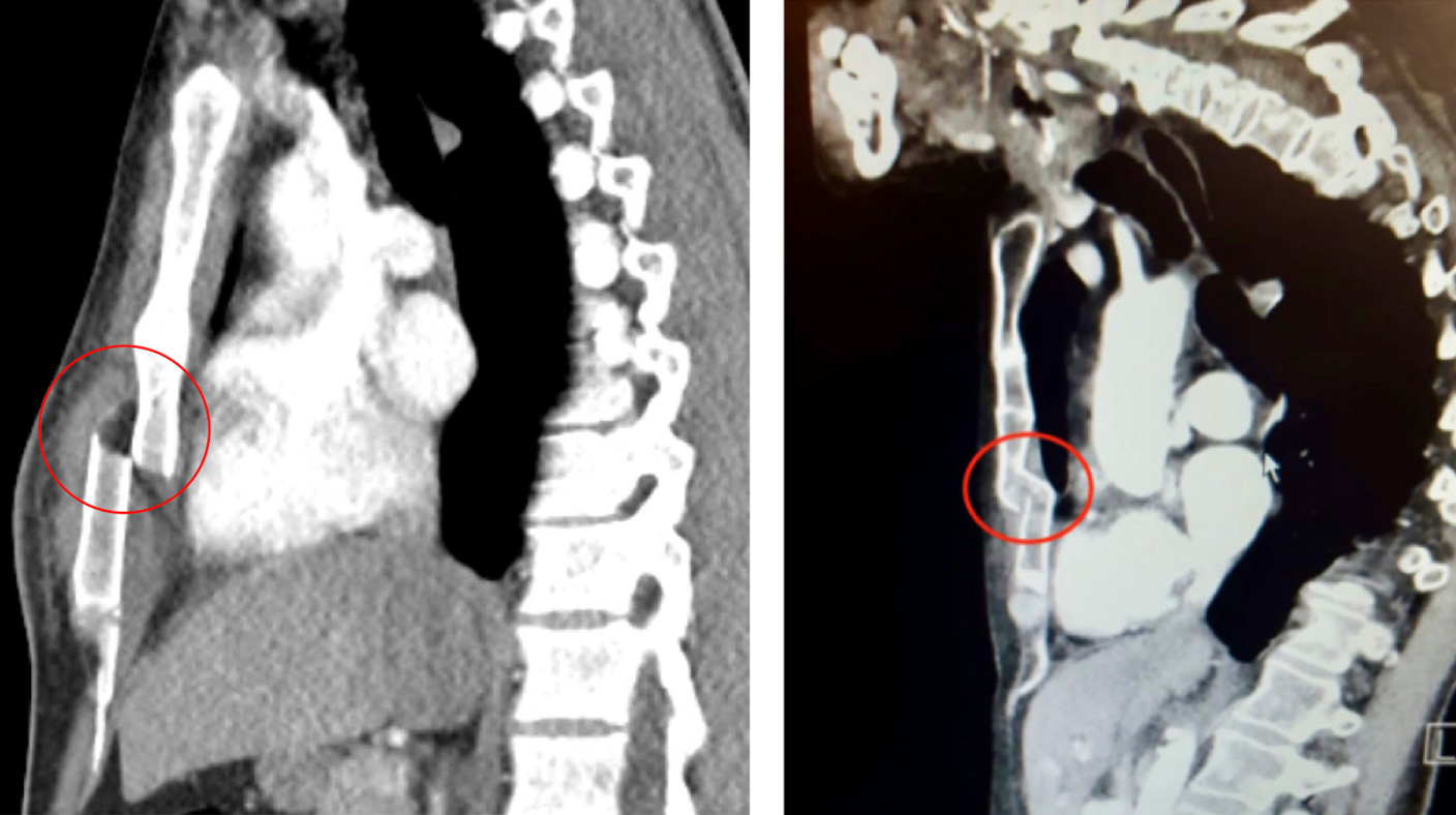 Collection of blood (haemothorax) prior to rib fixation