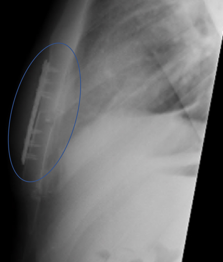 Collection of blood (haemothorax) prior to rib fixation