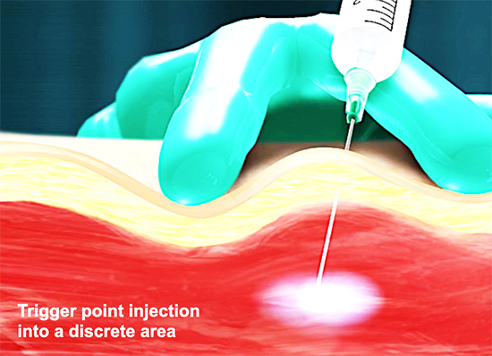 Trigger point injection into a discrete area