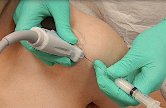 Injection into the shoulder under ultrasound guidance