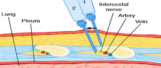 Trigger point injections