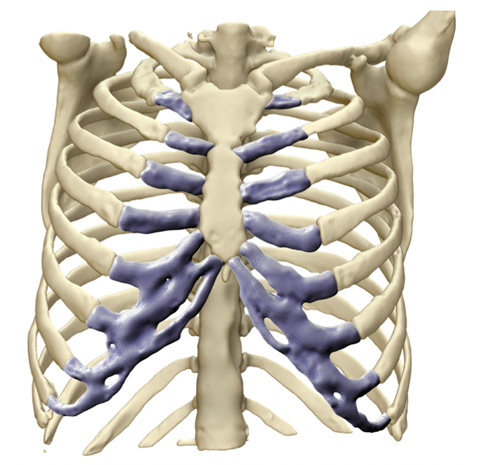 Diagnosis Chest Wall Skeleton Front View