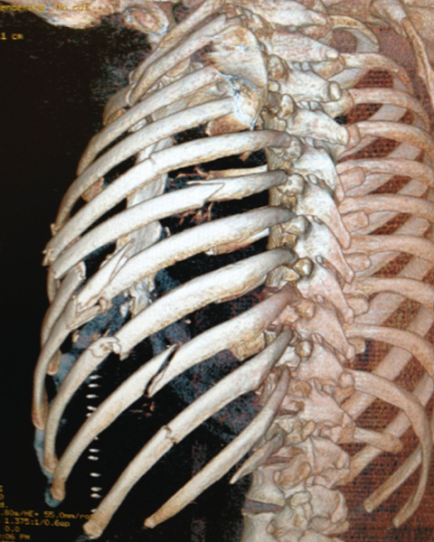 Investigations Chest CT Scan 3D reconstruction