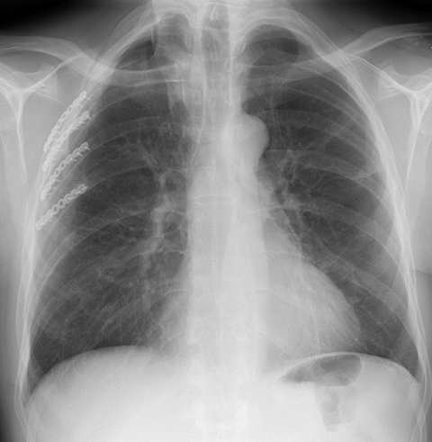 Treatment Chest X Ray After