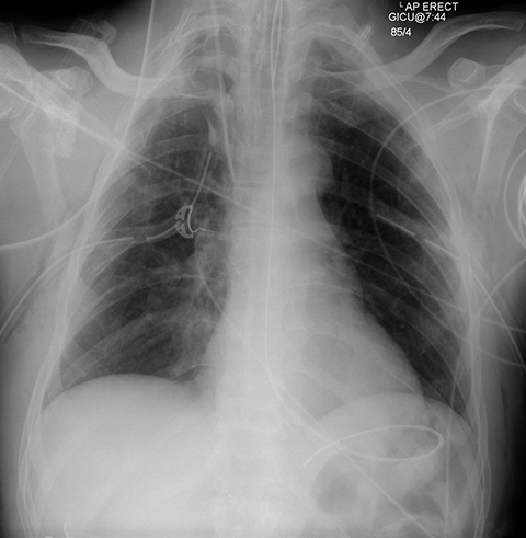 Treatment Chest X Ray Before